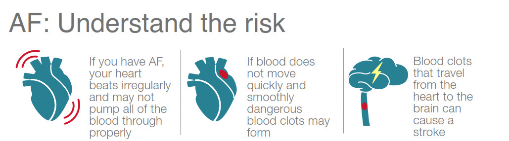 2018 10 11 20 21 00 - Atrial Fibrillation raises risk of stroke by 5: can you tell if you have it? - Stroke Rehabilitation and Exercise Training for Survivors & Specialist Stroke Courses for Therapists and Trainers, Online and Face to Face