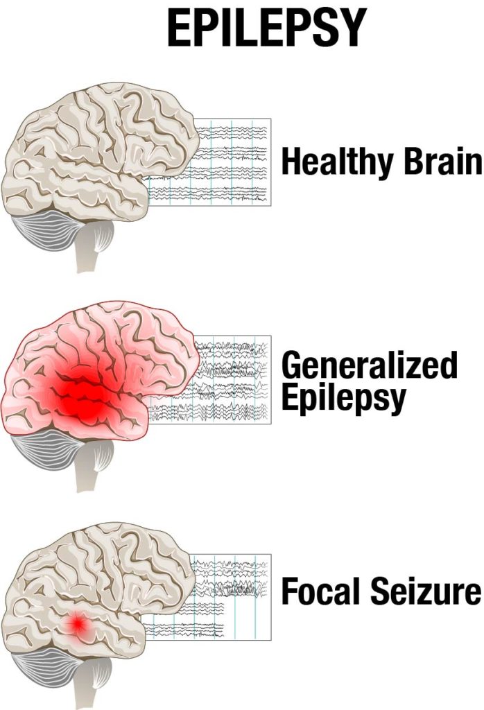 arni epilepsy 698x1024 - How do I Cope with Epilepsy after Stroke? - Stroke Rehabilitation and Exercise Training for Survivors & Specialist Stroke Courses for Therapists and Trainers, Online and Face to Face