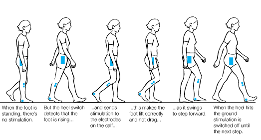 FES image - HOW TO GET ROUND FOOT-DROP AFTER STROKE - Stroke Rehabilitation and Exercise Training for Survivors & Specialist Stroke Courses for Therapists and Trainers, Online and Face to Face