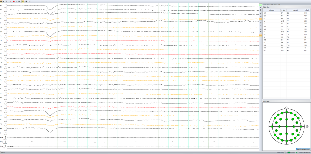 EEG data 1024x506 - CAN 'BRAIN-WAVES' ENHANCE RECOVERY FROM STROKE? - Stroke Rehabilitation and Exercise Training for Survivors & Specialist Stroke Courses for Therapists and Trainers, Online and Face to Face